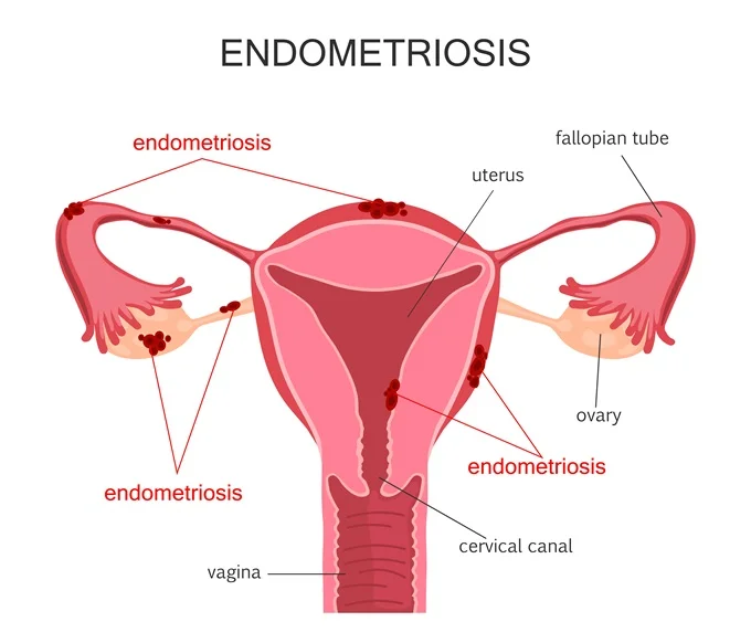 Endometriosis is a condition where the tissue that lines the uterus, known as the endometrium, grows outside the uterus