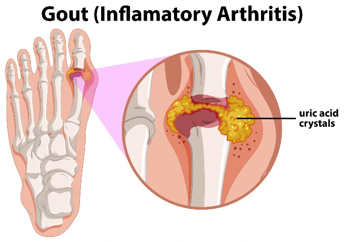 Gout is a form of inflammatory arthritis, and it causes painful swelling in joints.