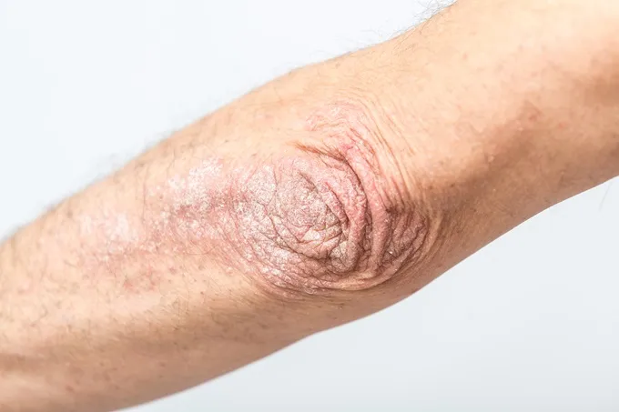 Psoriatic Arthritis can cause a red, scaly skin rash called psoriasis.