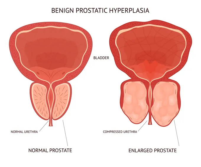 Prostate enlargement is known as benign prostatic hypertrophy (BPH)