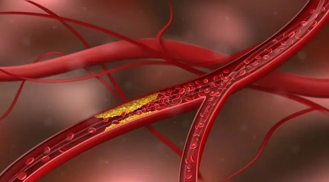 An excess of cholesterol creates a build-up in the arteries, narrowing the artery walls.